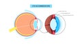 Eye accommodation poster Royalty Free Stock Photo