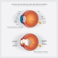 Eye Anatomy with Eye Abnormalities Royalty Free Stock Photo