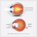 Eye Anatomy with Eye Abnormalities Royalty Free Stock Photo