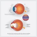 Eye Anatomy with Eye Abnormalities Royalty Free Stock Photo