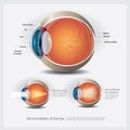 Eye Anatomy with Eye Abnormalities Royalty Free Stock Photo