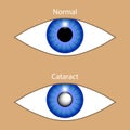 Eye with cataract and normal. Vector illustration of healthy and illness optic organ. Blurred vision in glaucoma. Diagnosis and