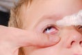 Eye child allergy and conjunctivitis red allergic, childhood