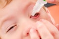 Eye child allergy and conjunctivitis red allergic, health bloodshot