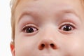 Eye child allergy and conjunctivitis red allergic, pinkeye