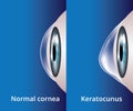 Eye cornea and keratoconus, eye disorder, medical vector Royalty Free Stock Photo