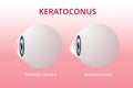 Eye cornea and keratoconus, eye disorder, medical vector Royalty Free Stock Photo