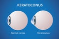 Eye cornea and keratoconus, eye disorder, medical vector