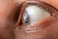 eye with corneal dystrophy closeup, keratoconus disease thinning of the cornea