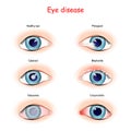 Eye disease. comparison and difference