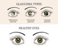 Eye disease. Ophthalmology health illustration.