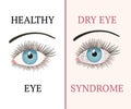 Eye disease. Ophthalmology health illustration.