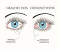 Eye disease. Ophthalmology health illustration.