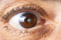 Eye of an elderly man with cataracts, clouding of the lens, macro.