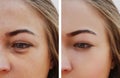 Eye girl bag under the eyes removal before and after treatment cosmetic procedures