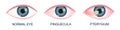 Eye healthy, with pinguecula and pterygium growing onto cornea. Conjunctival degeneration. Eye disease. Human organ of