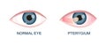 Eye healthy and with pterygium. Conjunctival degeneration before and after surgery. Eye disease. Human organ of vision Royalty Free Stock Photo