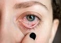 ÃÂ¡onjunctivitis. Pinkeye. Woman`s eye. Eye disease. Closed up