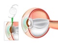 Eye Lens Replacement Surgery. Lens Implant. Cataract Surgery. Intraocular Lenses IOL. Royalty Free Stock Photo