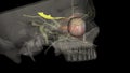 Eye movement pupil constriction. Trochlear Nerve, Eye movement .