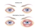 Eye with periorbital cellulitis Royalty Free Stock Photo