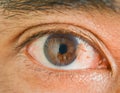 Eye pterygium in man Royalty Free Stock Photo