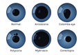 Eye pupils set with disease vector illustration