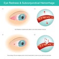 Eye Redness & Subconjunctival Haemorrhage. Royalty Free Stock Photo