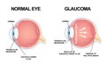 Eye structure. Anatomy of an eye defect, Glaucoma Royalty Free Stock Photo