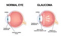 Eye structure. Anatomy of an eye defect, Glaucoma