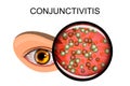 Eye suffering from conjunctivitis and styes