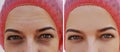 Eye swelling, wrinkles before and after cosmetic procedure