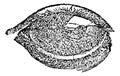 Eye with Vesicular or Pustular Keratitis, vintage engraving