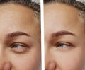 Eye wrinkles young woman before and after closeup cosmetology procedures Royalty Free Stock Photo