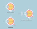 Eyeball anatomy, internal organs body part nervous system, hyperopia concept