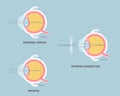 Eyeball anatomy, internal organs body part nervous system, myopia concept