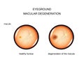 Eyeground. degeneration of the macula