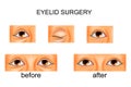 Eyelid surgery, plastic surgery