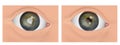 Eyes before and after cataract removal with and without problem. Cataracts and healthy eye. Royalty Free Stock Photo