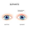 Eyes of human. Blepharitis. Crusting at the eyelid margins