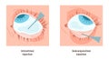 Eyes injection types. Intravitreal and subconjunctival injection. Administration Royalty Free Stock Photo