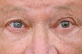 Eyes of a senior man showing unequal pupil dilation