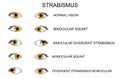Eyes. types of strabismus Royalty Free Stock Photo