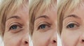 Eyes woman face wrinkles, before and after procedures Royalty Free Stock Photo
