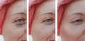 Eyes woman face wrinkles, patient before and after procedures Royalty Free Stock Photo