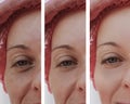 Eyes woman face wrinkles, patient before and after procedures health Royalty Free Stock Photo