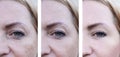 Eyes woman face wrinkles pigmentation , patient before and after procedures health Royalty Free Stock Photo