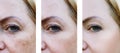 Eyes woman face wrinkles pigmentation , lifting patient before and after procedures health Royalty Free Stock Photo