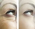 eyes of a woman`s wrinkles, before after procedures rejuvenation procedures treatments results Royalty Free Stock Photo