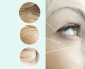 Eyes of a woman wrinkles aging regeneration lifting removal collage before and after, procedures Royalty Free Stock Photo